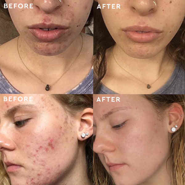 ชาเขียว ครีมบํารุงผิวหน้า ชุดแพ็คเกจ เจลล้างผิวหน้า นิอาซินามิด เซรั่มสําหรับผิวไขมัน