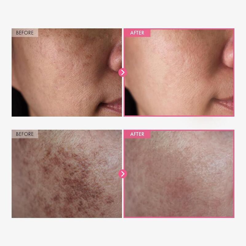 OEM ODM arbutin 7%+tranexamic acid 4% face cream 70000ppm arbutin 40000 ppm TXA nicotinamide glutathione anti-aging whitening customizable ingredients