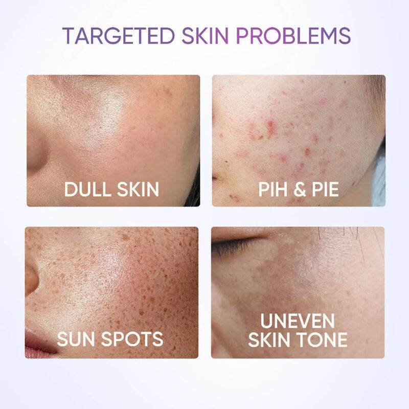 OEM ODM brand customized 377 face cream Nicotinamide shea butter anti acne whitening lightening spot moisturizing face cream skin care product
