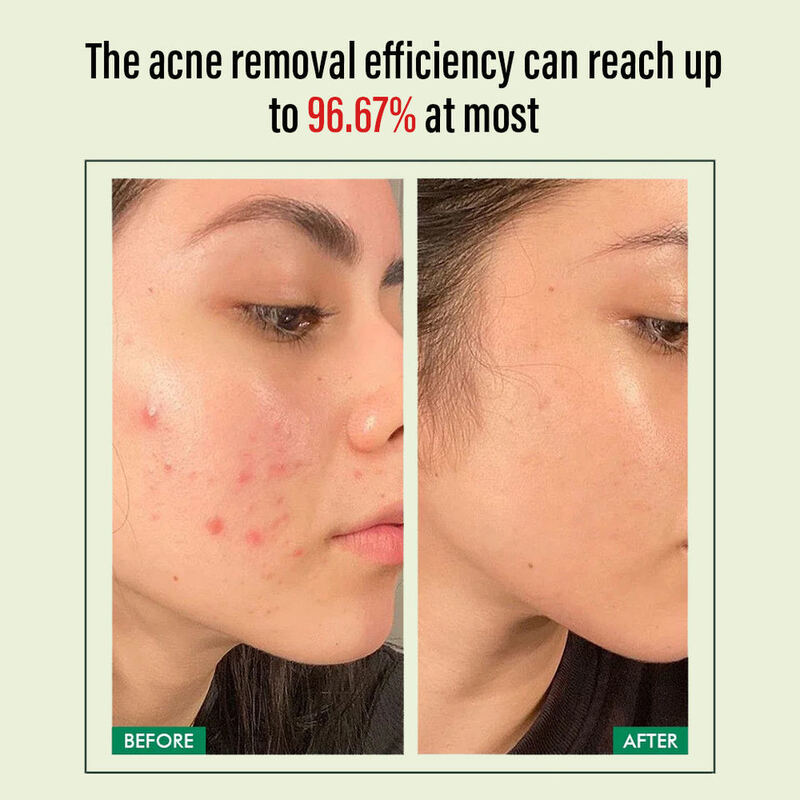 OEM ODM NK Cell Customized Revitalizing Face Cream NAD+ Nighttime Women's Acne Scar Redness Spot-Reducing Facial Skincare Cream