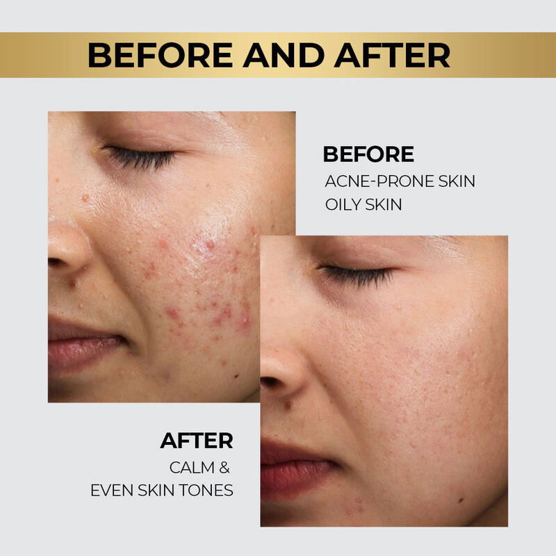 OEM ODM Brand ExosomeFacial Serum essence Nicotinamide Anti aging Acne Control Centella B5 AHA+BHA+PHA Pore Shrinkage Oil Skin Care Serum