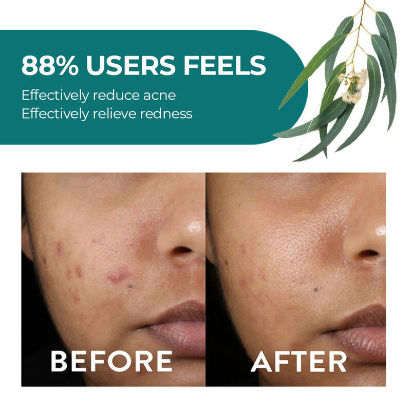 OEM ODM Natural Skin Care Set Anti Acne face cream Eucalyptus Tea Tree Skin Care Water Emulsion Wood Fruit Oil Soothing Sensitive Skin essence Whitening Anti Wrinkle Firming face cream Body Lotion