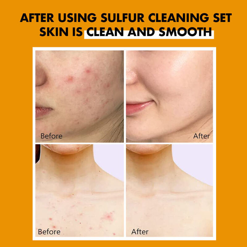 OEM ODM Korean brand facial cleanser sulfur whitening and acne treatment oil control cleanser shrinks pores and cleanses the face