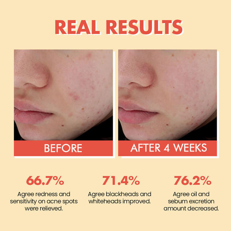 OEM ODM brand organic natural skin care essence product to repair sensitive redness, swelling, acne, treat and soothe women's face essential oil