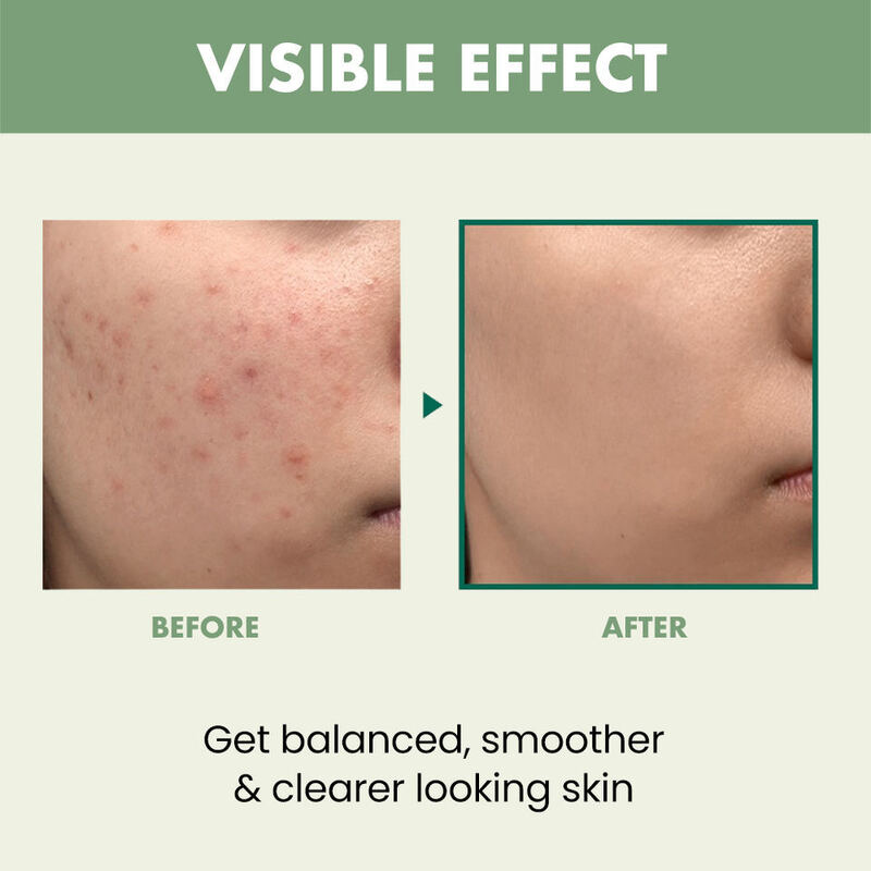 OEM ODM customized private brand skin care gel effective and fast acne removing tea tree oil acne scar removing gel