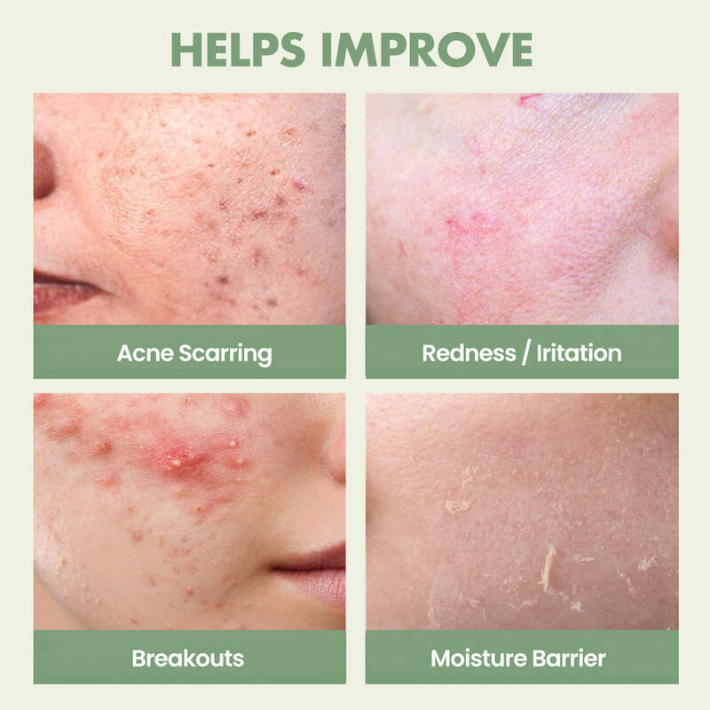 OEM ODM Tea Tree Acne Removing Repair Facial Serum Blackhead Remover Skin Care Acne Removing Treatment essence Serum Private Brand